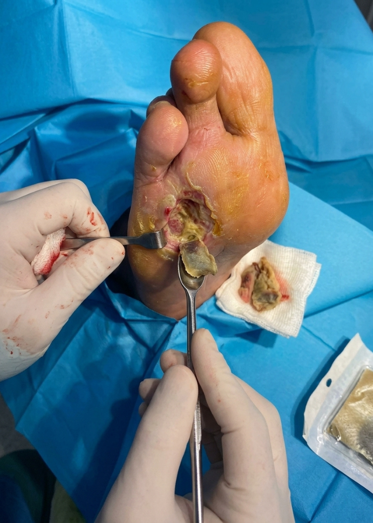 Our Services diabetic foot surgery Advanced diabetic foot surgery in Surat