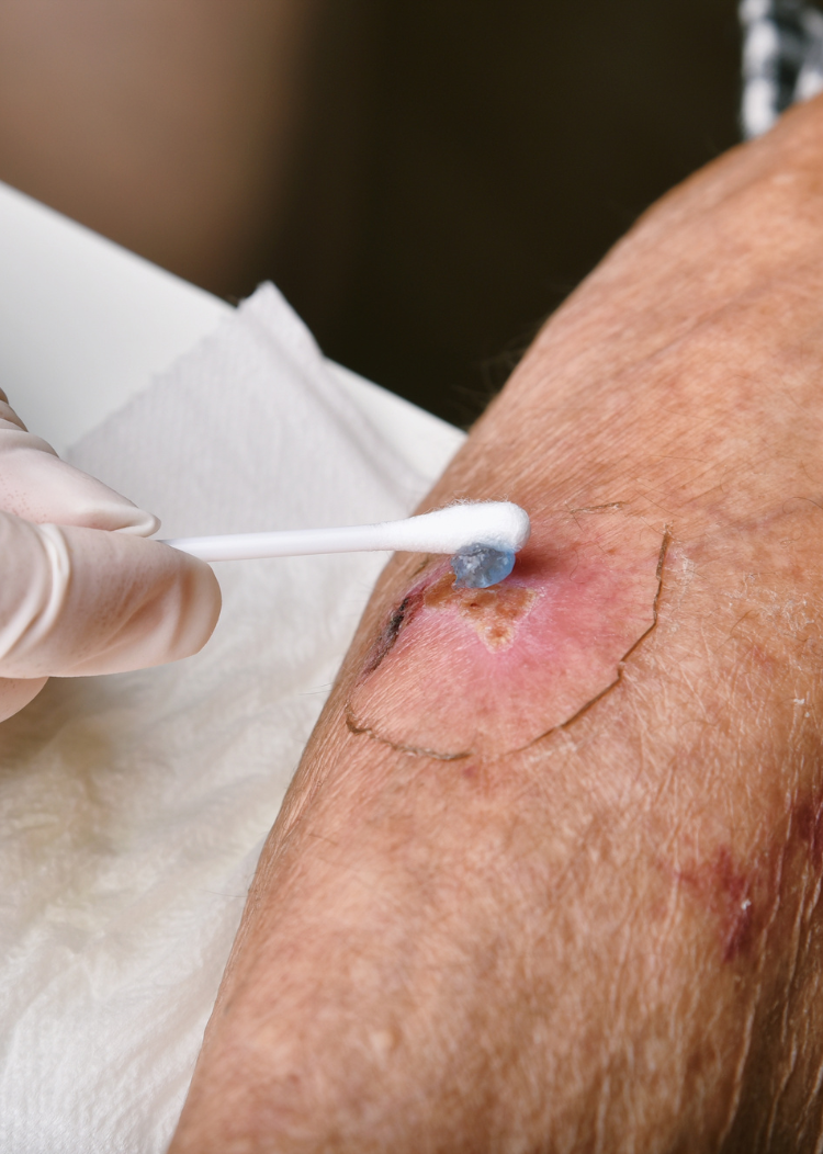 Our Services non surgical Non-surgical treatment for diabetic foot ulcers