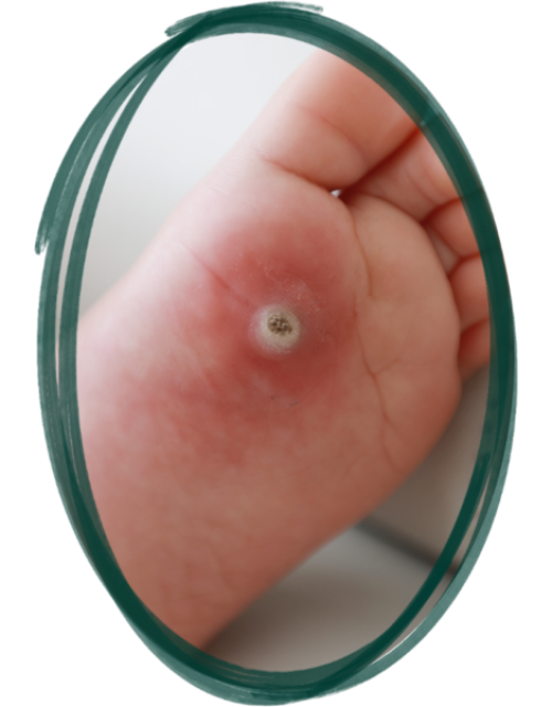 Advanced diabetic foot treatment